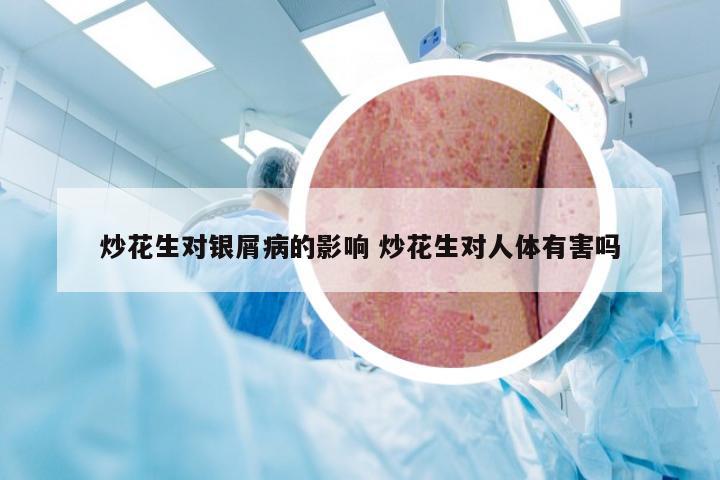 炒花生对银屑病的影响 炒花生对人体有害吗