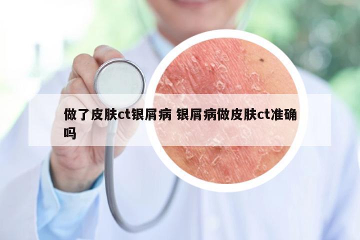 做了皮肤ct银屑病 银屑病做皮肤ct准确吗