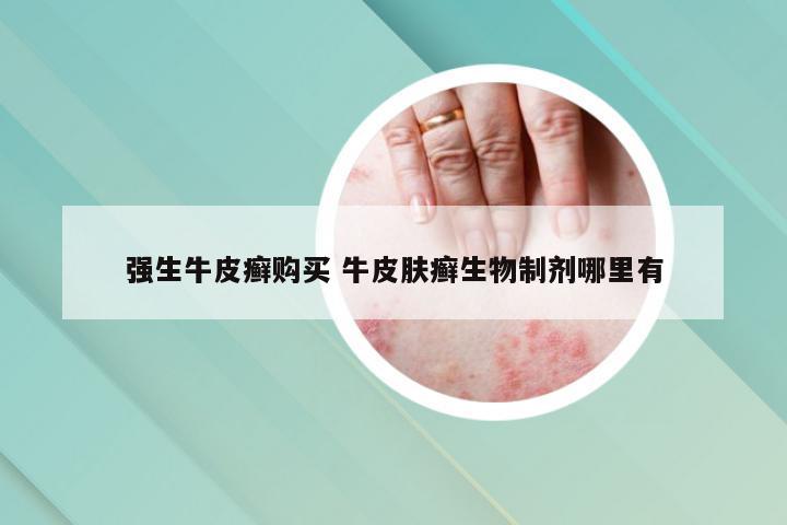强生牛皮癣购买 牛皮肤癣生物制剂哪里有