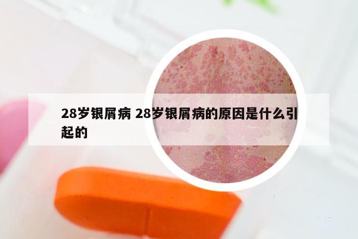 28岁银屑病 28岁银屑病的原因是什么引起的