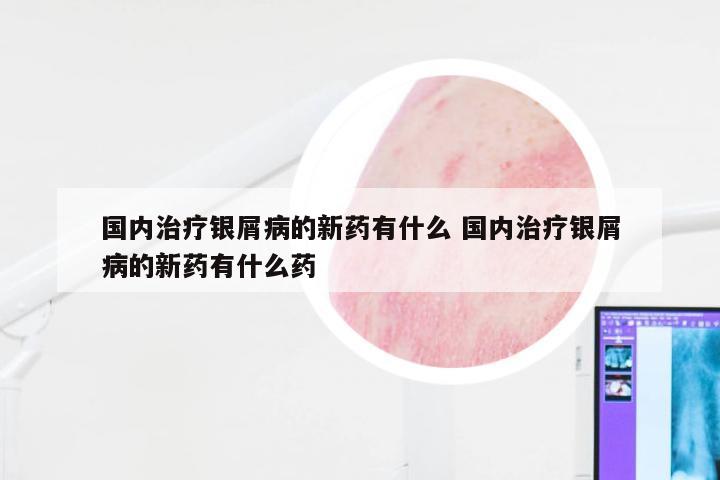 国内治疗银屑病的新药有什么 国内治疗银屑病的新药有什么药