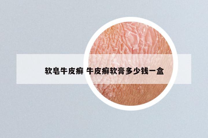 软皂牛皮癣 牛皮癣软膏多少钱一盒