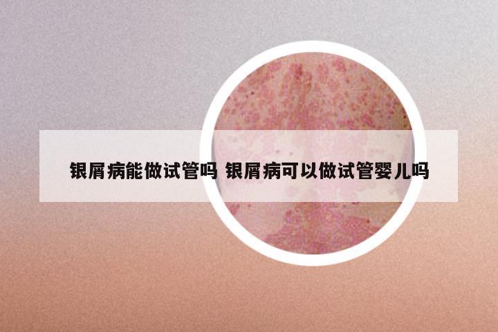 银屑病能做试管吗 银屑病可以做试管婴儿吗