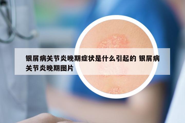 银屑病关节炎晚期症状是什么引起的 银屑病关节炎晚期图片
