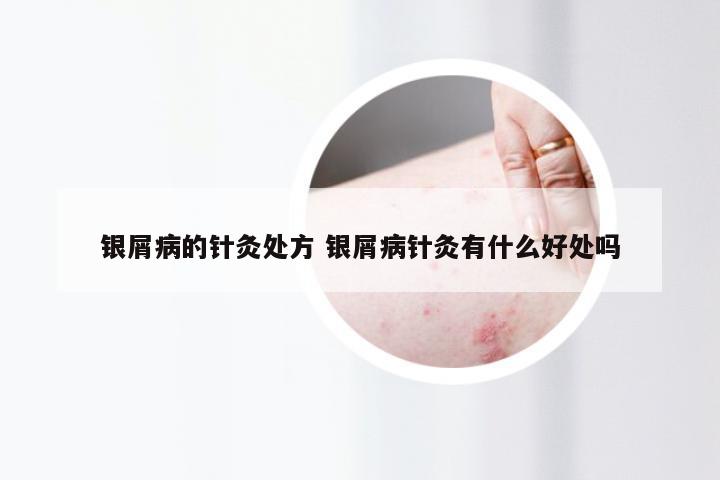 银屑病的针灸处方 银屑病针灸有什么好处吗