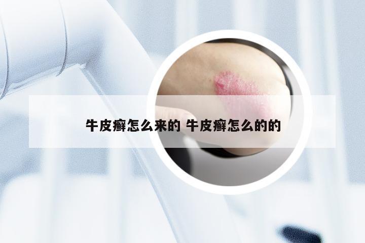 牛皮癣怎么来的 牛皮癣怎么的的