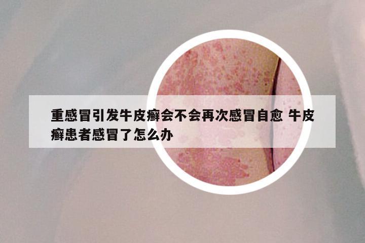 重感冒引发牛皮癣会不会再次感冒自愈 牛皮癣患者感冒了怎么办