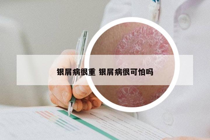 银屑病很重 银屑病很可怕吗