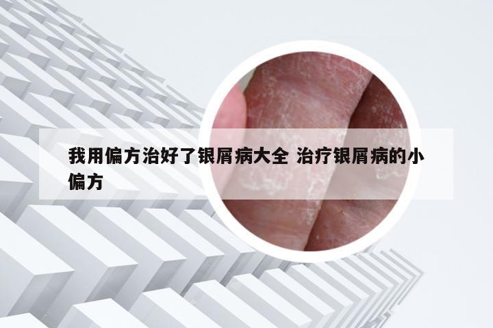 我用偏方治好了银屑病大全 治疗银屑病的小偏方