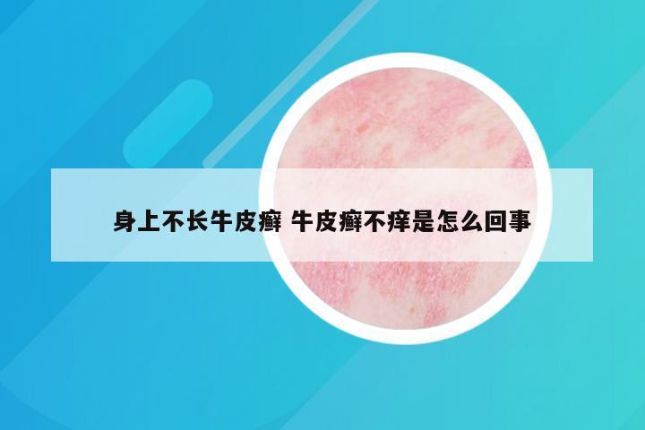 身上不长牛皮癣 牛皮癣不痒是怎么回事