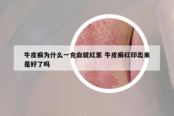 牛皮癣为什么一充血就红紫 牛皮癣红印出来是好了吗