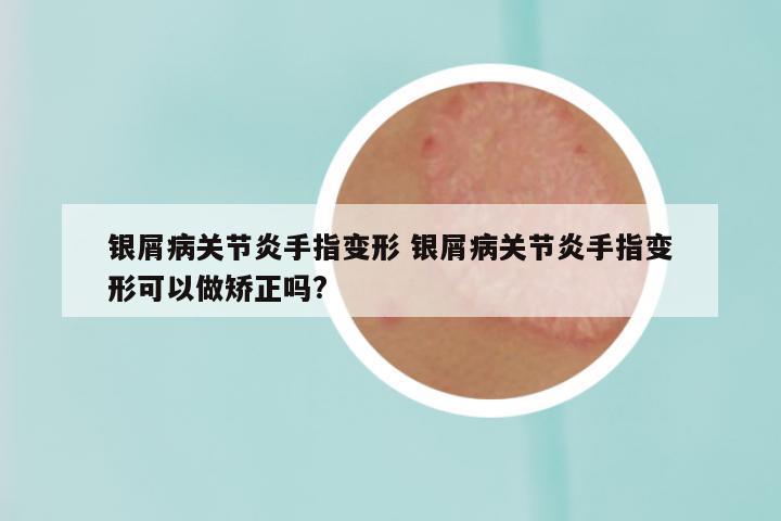 银屑病关节炎手指变形 银屑病关节炎手指变形可以做矫正吗?