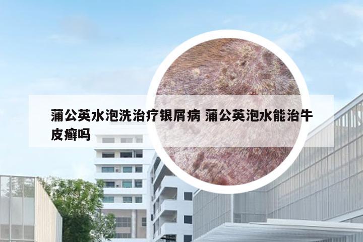 蒲公英水泡洗治疗银屑病 蒲公英泡水能治牛皮癣吗