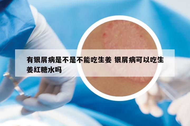 有银屑病是不是不能吃生姜 银屑病可以吃生姜红糖水吗