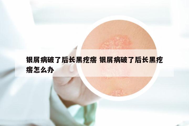 银屑病破了后长黑疙瘩 银屑病破了后长黑疙瘩怎么办