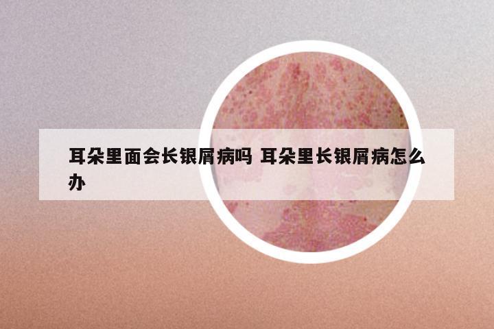 耳朵里面会长银屑病吗 耳朵里长银屑病怎么办