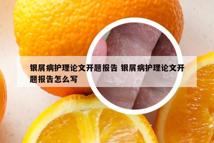 银屑病护理论文开题报告 银屑病护理论文开题报告怎么写