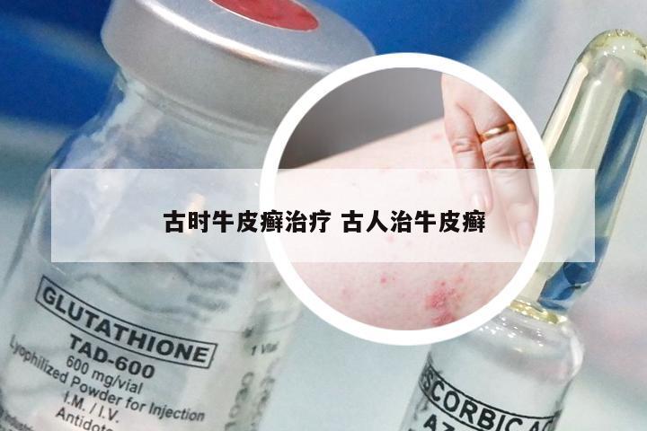 古时牛皮癣治疗 古人治牛皮癣