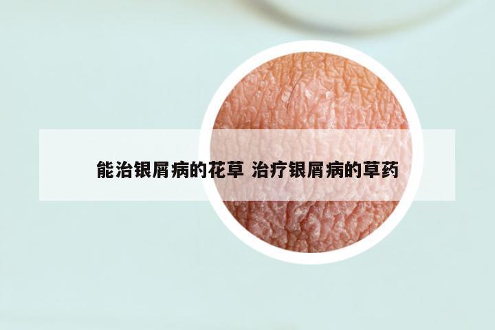 能治银屑病的花草 治疗银屑病的草药