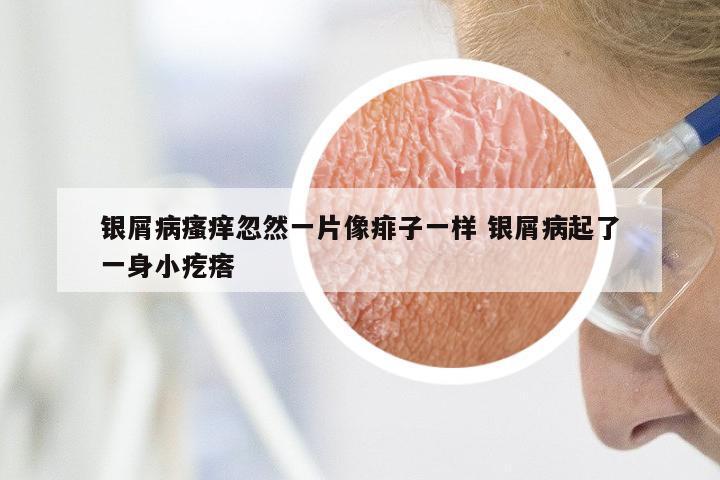 银屑病瘙痒忽然一片像痱子一样 银屑病起了一身小疙瘩