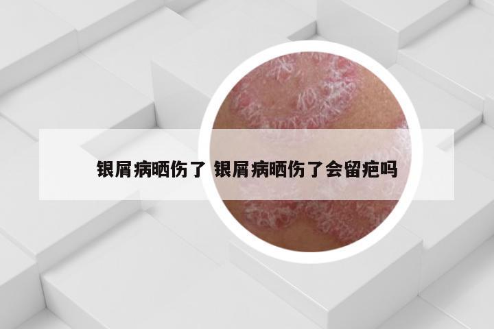 银屑病晒伤了 银屑病晒伤了会留疤吗