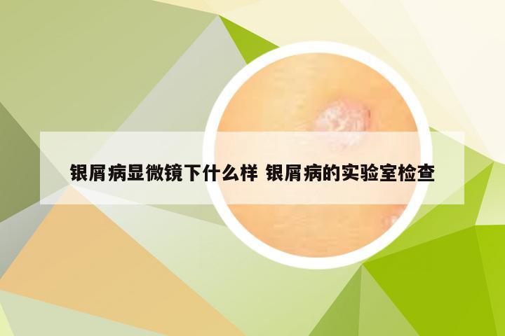 银屑病显微镜下什么样 银屑病的实验室检查