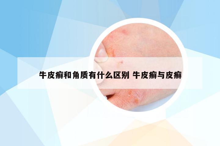 牛皮癣和角质有什么区别 牛皮癣与皮癣