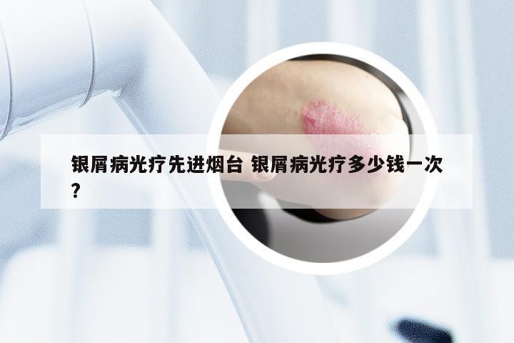 银屑病光疗先进烟台 银屑病光疗多少钱一次?