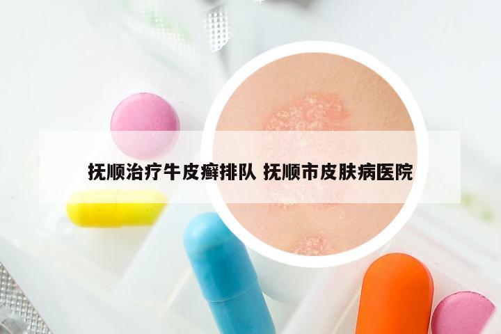 抚顺治疗牛皮癣排队 抚顺市皮肤病医院