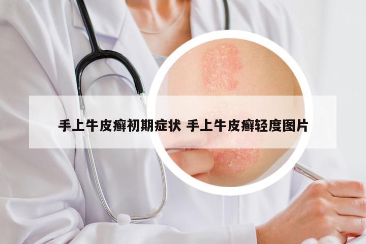 手上牛皮癣初期症状 手上牛皮癣轻度图片