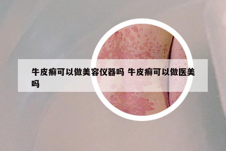 牛皮癣可以做美容仪器吗 牛皮癣可以做医美吗