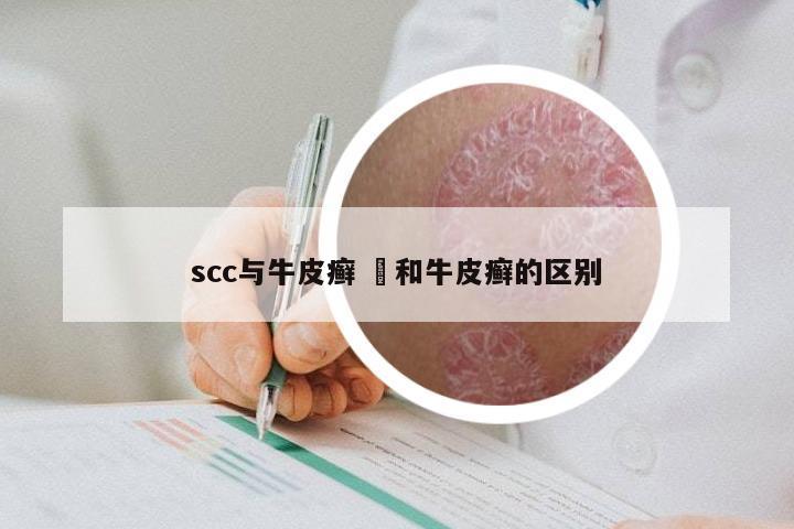 scc与牛皮癣 廯和牛皮癣的区别