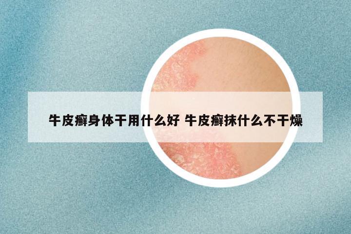 牛皮癣身体干用什么好 牛皮癣抹什么不干燥