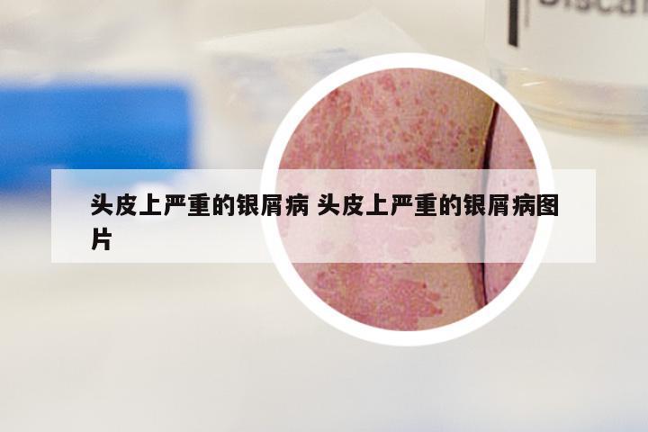 头皮上严重的银屑病 头皮上严重的银屑病图片