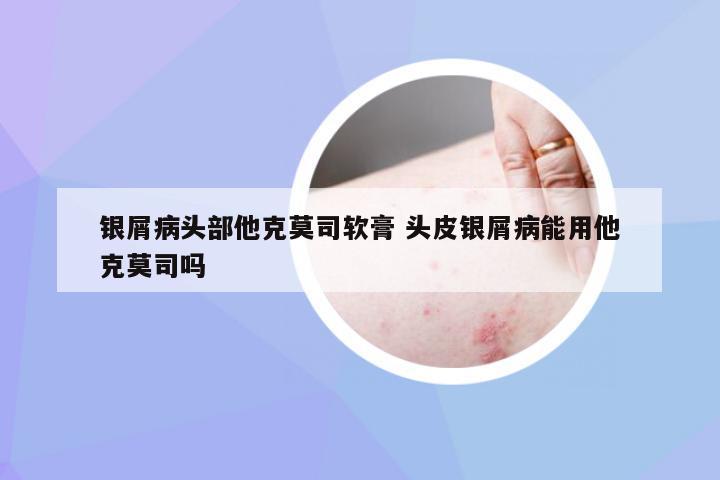 银屑病头部他克莫司软膏 头皮银屑病能用他克莫司吗