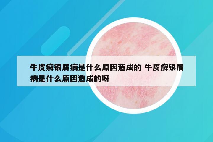 牛皮癣银屑病是什么原因造成的 牛皮癣银屑病是什么原因造成的呀