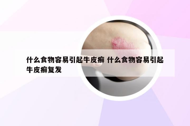 什么食物容易引起牛皮癣 什么食物容易引起牛皮癣复发
