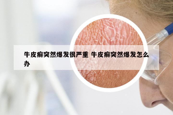 牛皮癣突然爆发很严重 牛皮癣突然爆发怎么办