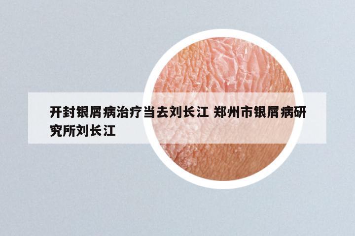 开封银屑病治疗当去刘长江 郑州市银屑病研究所刘长江