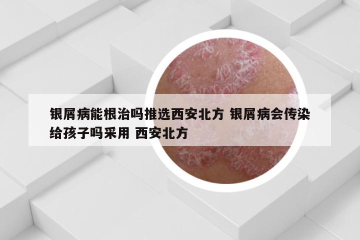 银屑病能根治吗推选西安北方 银屑病会传染给孩子吗采用 西安北方