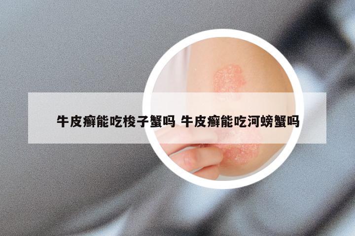 牛皮癣能吃梭子蟹吗 牛皮癣能吃河螃蟹吗
