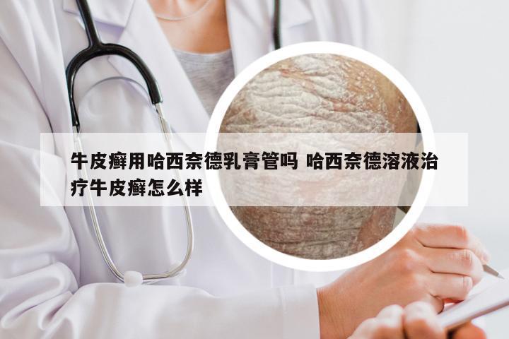 牛皮癣用哈西奈德乳膏管吗 哈西奈德溶液治疗牛皮癣怎么样