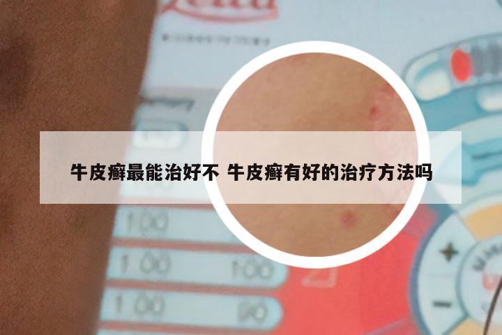 牛皮癣最能治好不 牛皮癣有好的治疗方法吗
