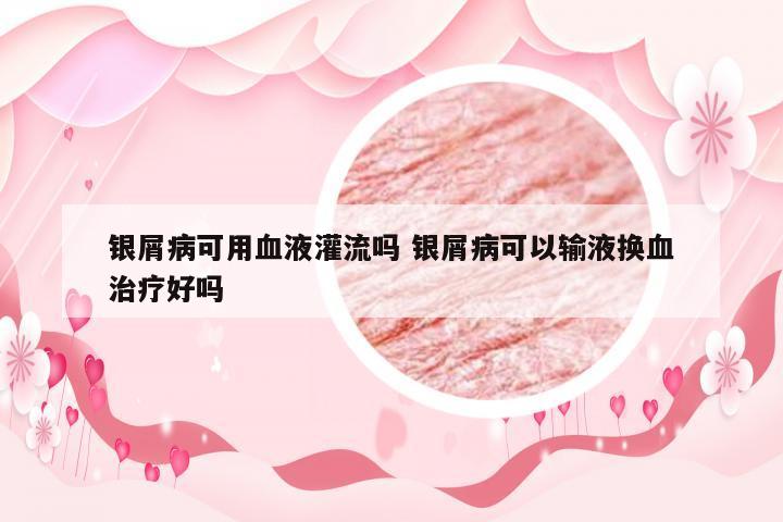 银屑病可用血液灌流吗 银屑病可以输液换血治疗好吗