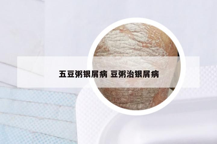 五豆粥银屑病 豆粥治银屑病
