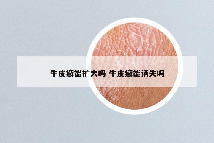 牛皮癣能扩大吗 牛皮癣能消失吗