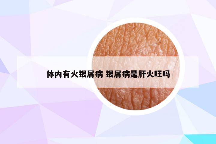 体内有火银屑病 银屑病是肝火旺吗