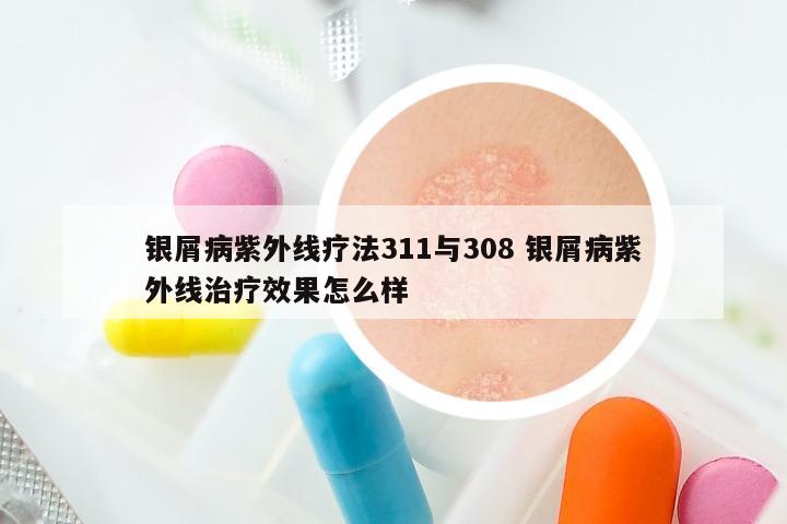银屑病紫外线疗法311与308 银屑病紫外线治疗效果怎么样