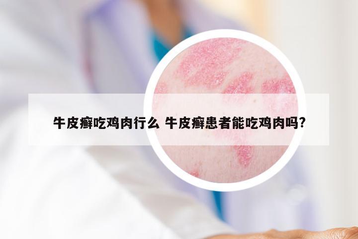 牛皮癣吃鸡肉行么 牛皮癣患者能吃鸡肉吗?