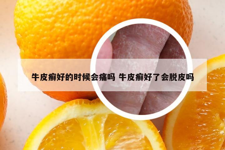 牛皮癣好的时候会痛吗 牛皮癣好了会脱皮吗